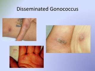Disseminated Gonococcus
 