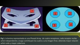 Fig 1. la bonina representada es una Phased Array, de cuatro receptores, cada receptor recibe
señal independiente y luego contribuyen los cuatro a una imagen final, obtenida mayor relación
señal ruido y mayor cobertura
 