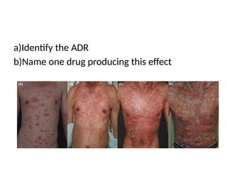 adverse drug reactions powerpoint slides | PPTX