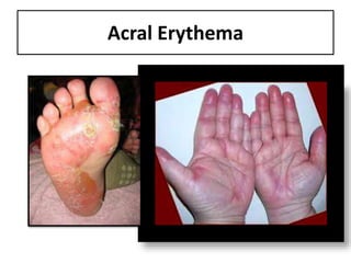 Acral Erythema
 