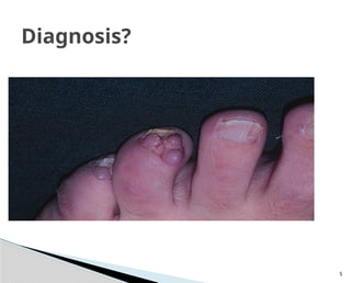 Podocon Application Rash Dermatology adverse drug reactions .pptx