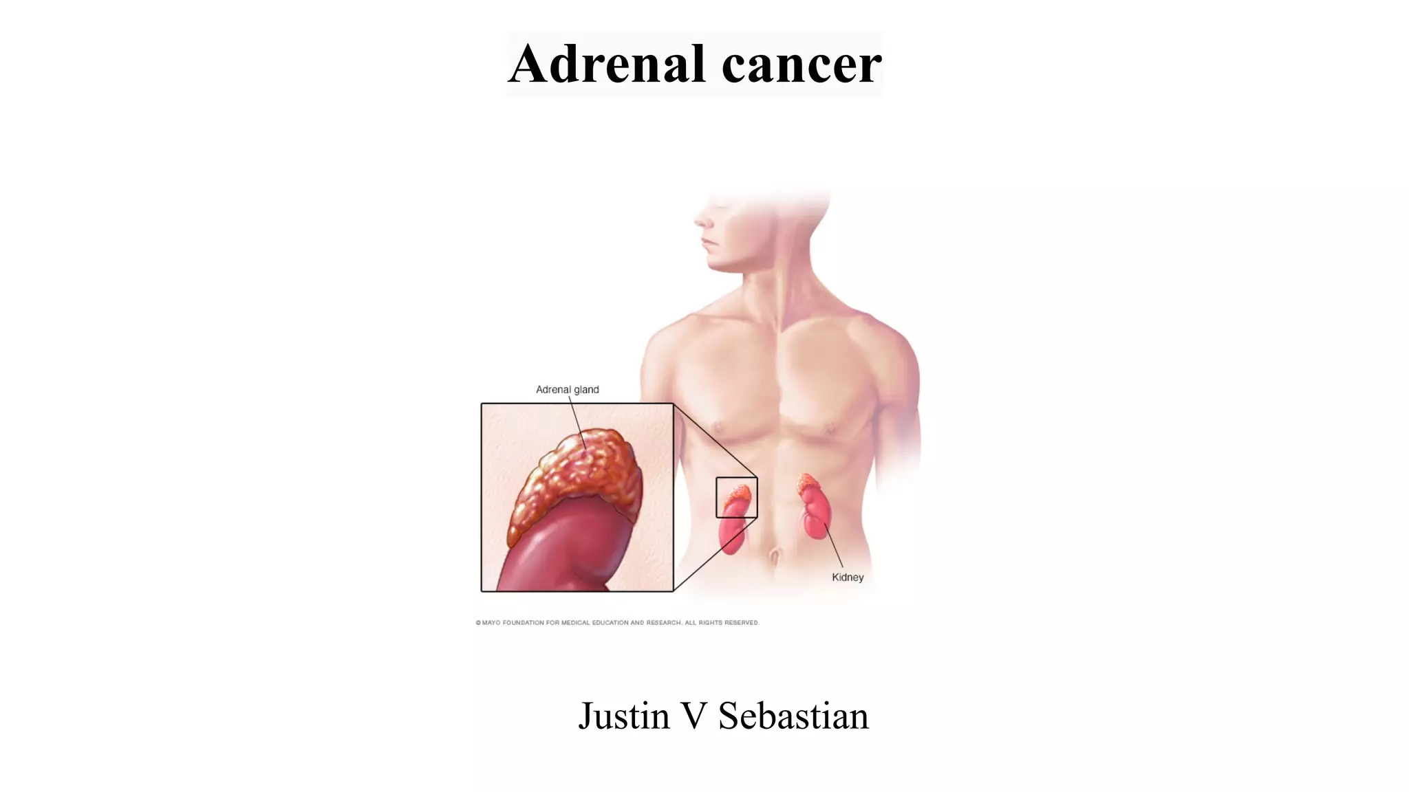 Picture of Adrenal cancer | PPT