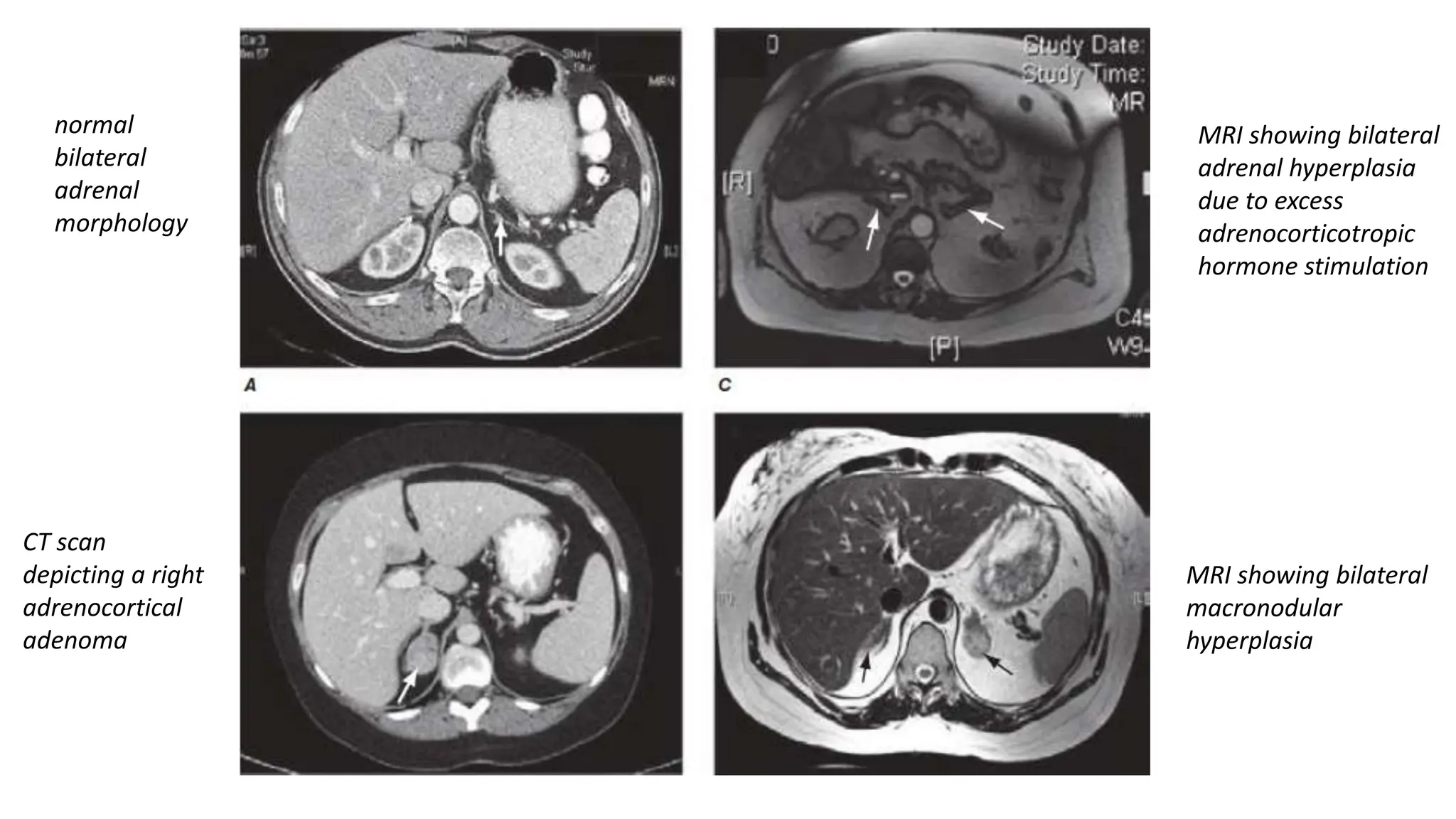 normal
bilateral
adrenal
morphology
CT scan
depicting a right
adrenocortical
adenoma
MRI showing bilateral
adrenal hyperplasia
due to excess
adrenocorticotropic
hormone stimulation
MRI showing bilateral
macronodular
hyperplasia
 
