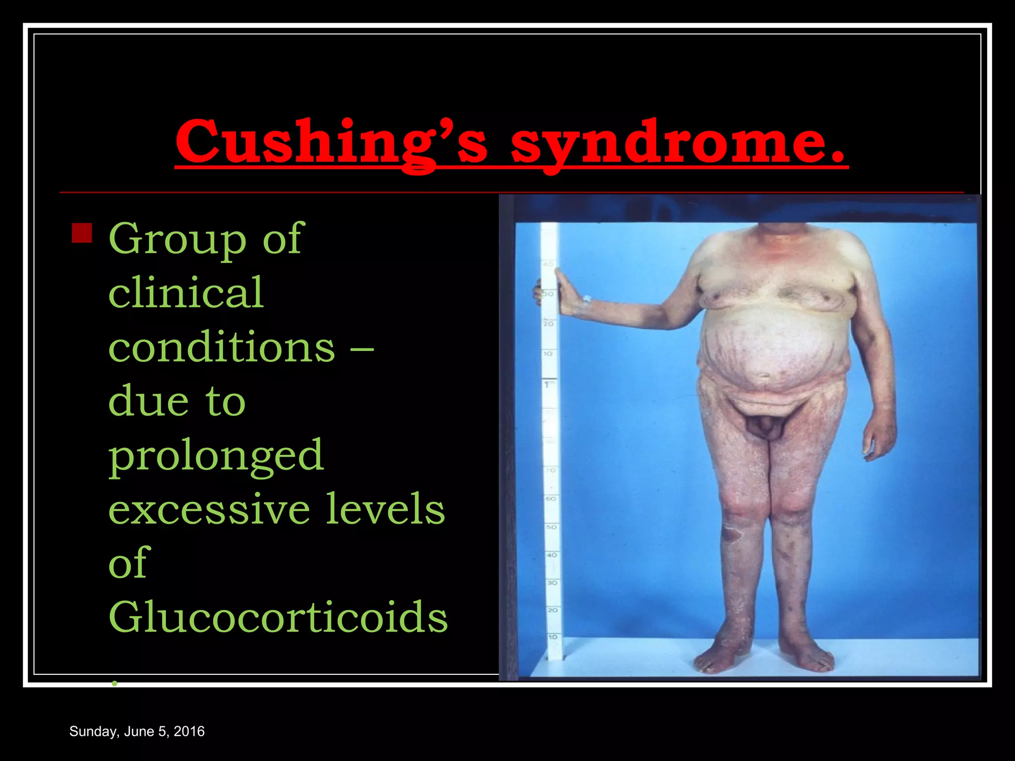 Cushing’s syndrome.
 Group of
clinical
conditions –
due to
prolonged
excessive levels
of
Glucocorticoids
.
Sunday, June 5, 2016
 