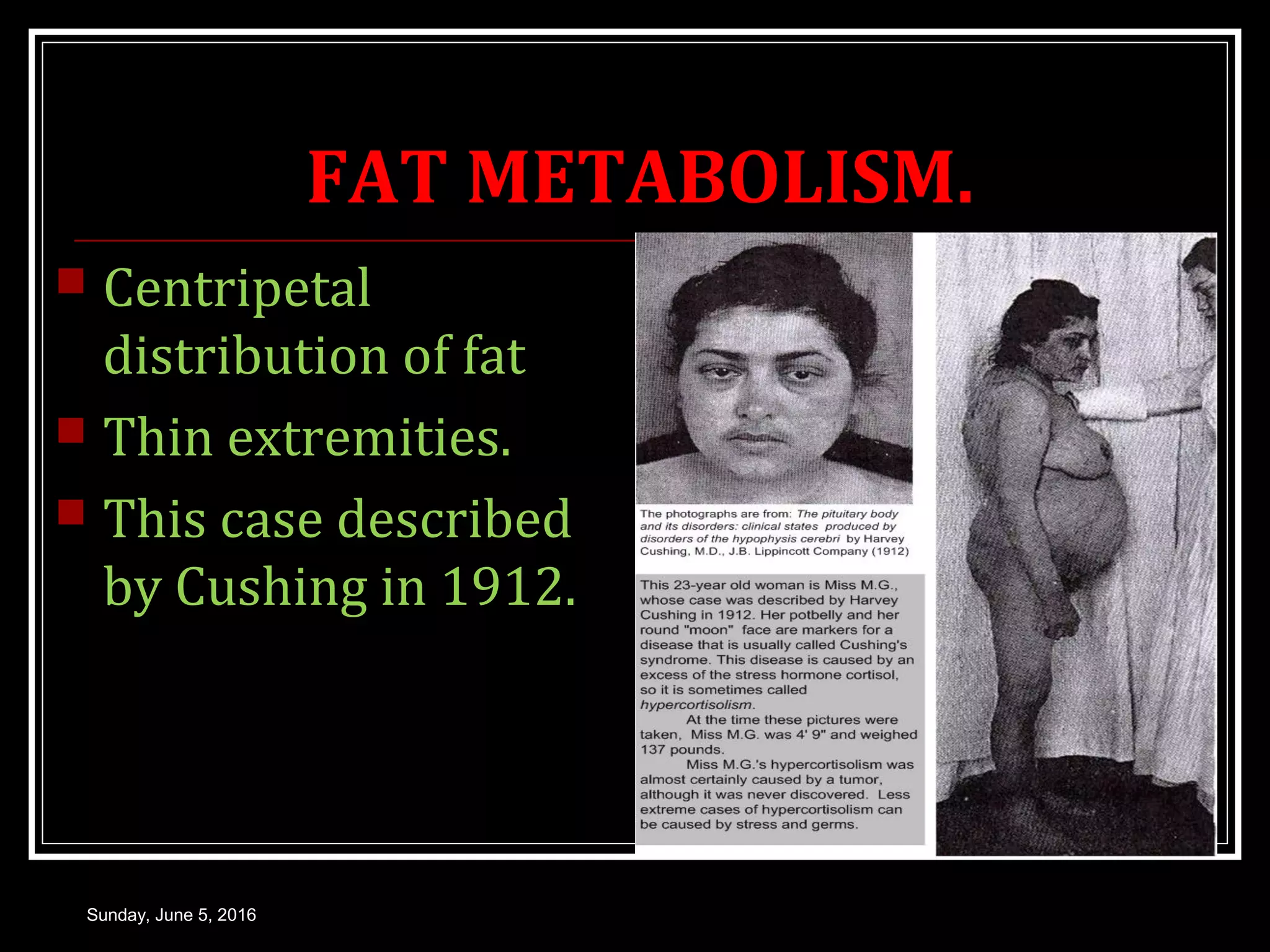 FAT METABOLISM.
Sunday, June 5, 2016
 Centripetal
distribution of fat
 Thin extremities.
 This case described
by Cushing in 1912.
 