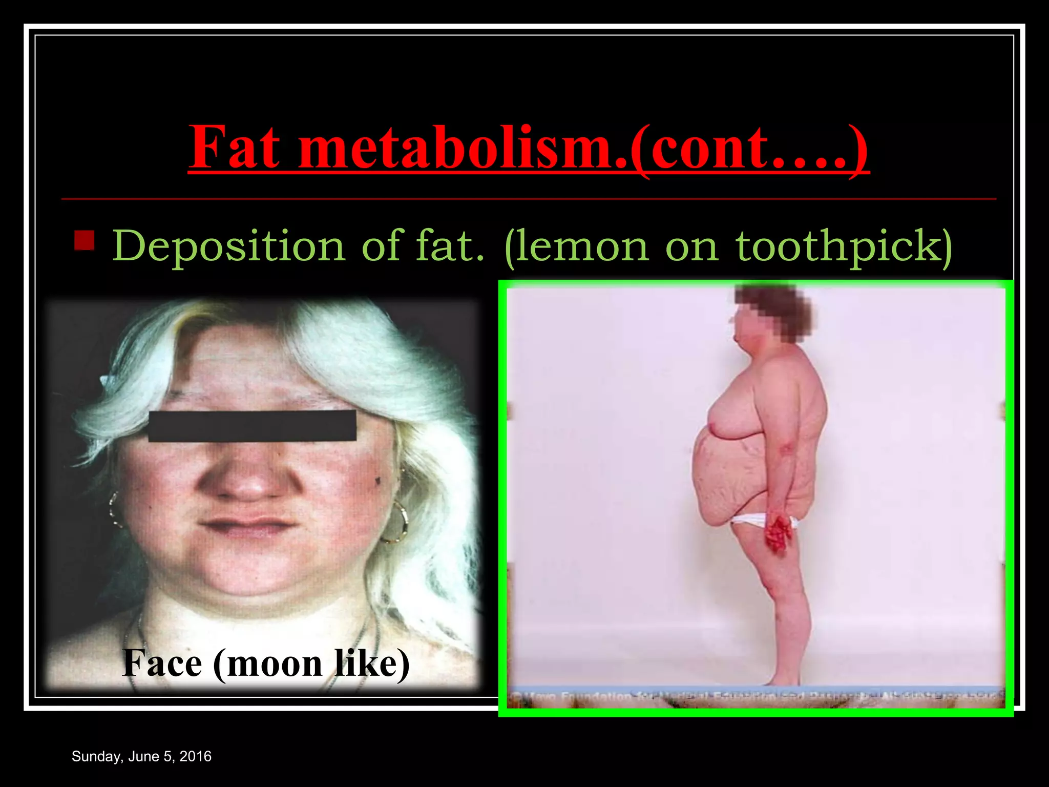 Fat metabolism.(cont….)
 Deposition of fat. (lemon on toothpick)
Sunday, June 5, 2016
Pendular abdomen.
Reddish purple striaeFace (moon like)
 