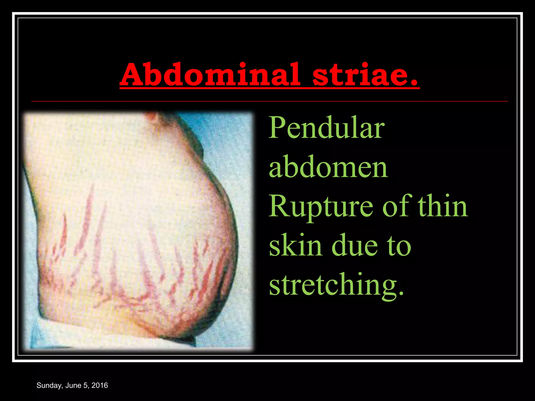Abdominal striae.
Sunday, June 5, 2016
Pendular
abdomen
Rupture of thin
skin due to
stretching.
 