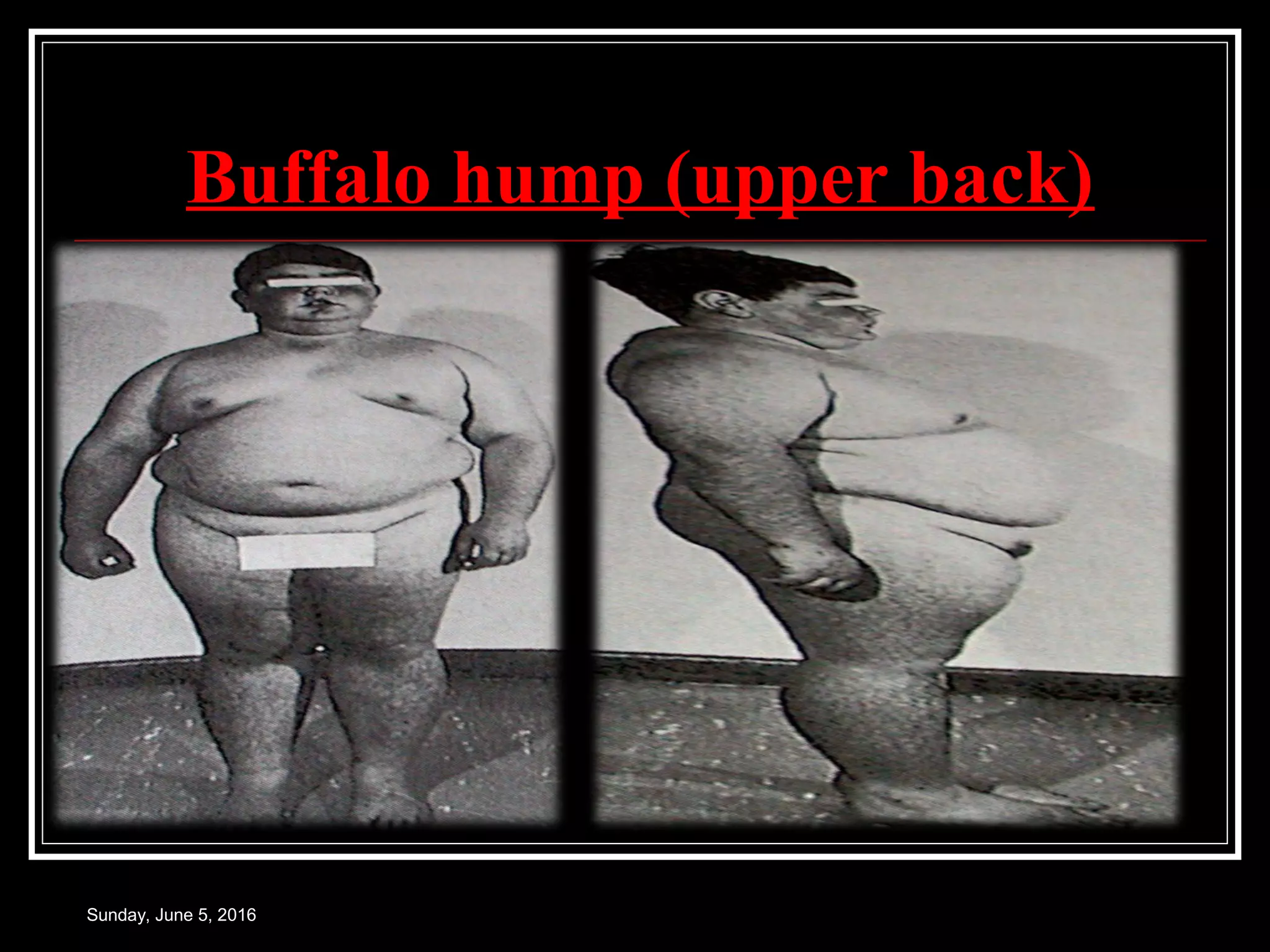 Buffalo hump (upper back)
Sunday, June 5, 2016
 