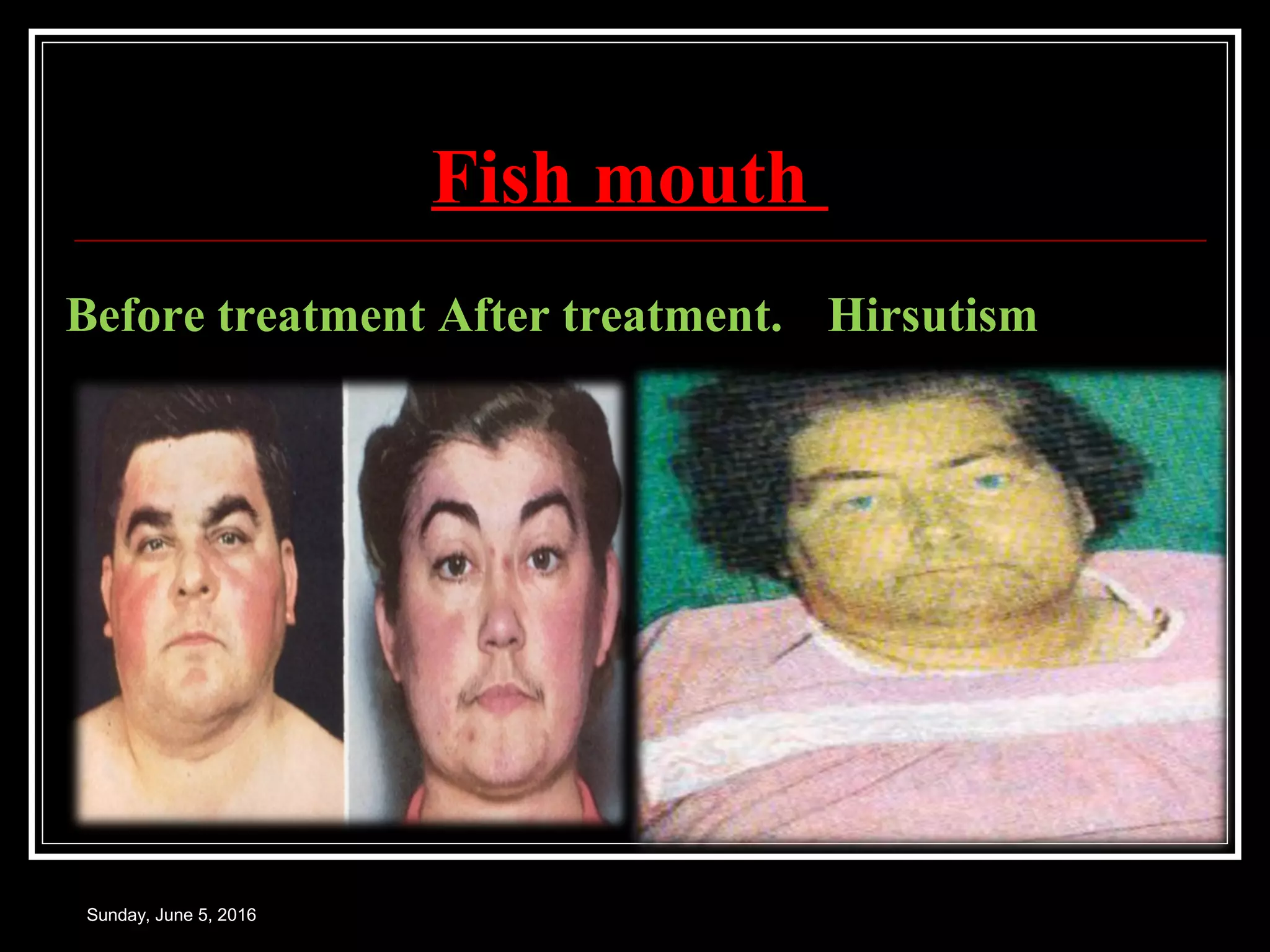 Fish mouth
Sunday, June 5, 2016
Before treatment After treatment. Hirsutism
 