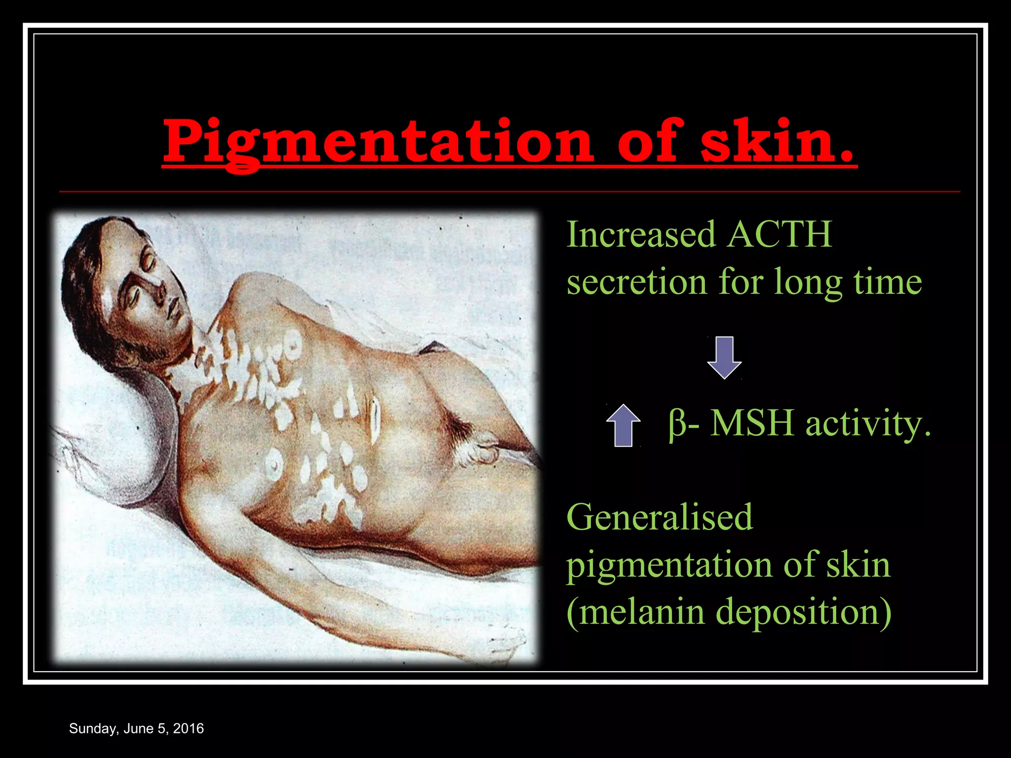 Pigmentation of skin.
Sunday, June 5, 2016
Increased ACTH
secretion for long time
β- MSH activity.
Generalised
pigmentation of skin
(melanin deposition)
 