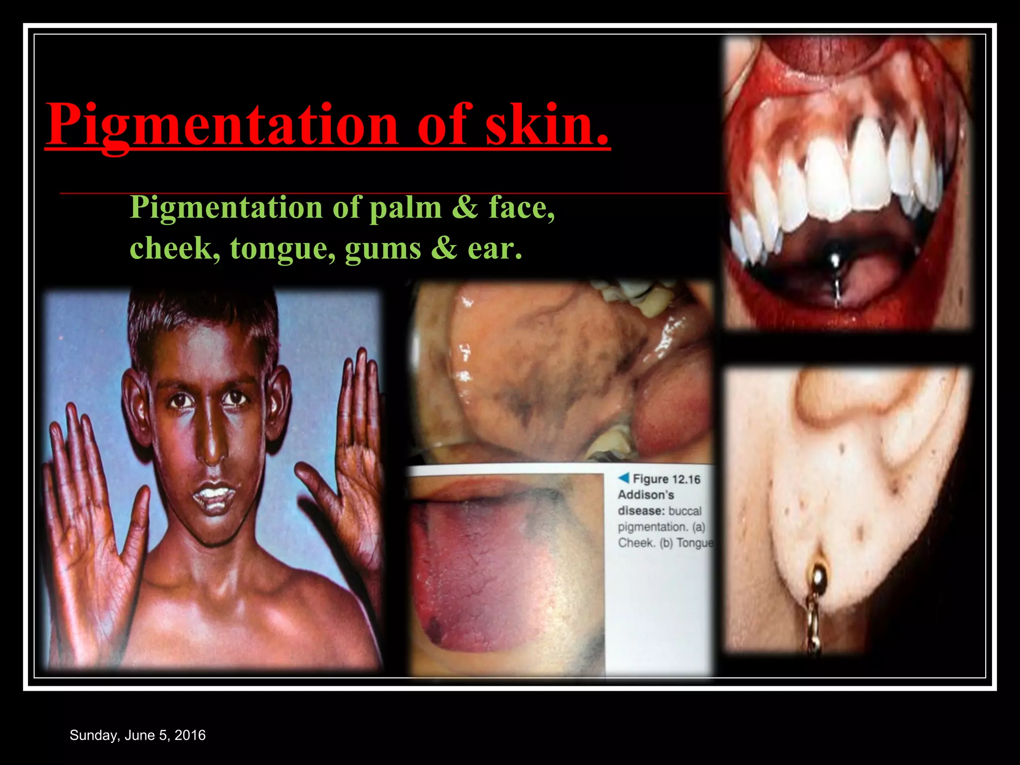 Pigmentation of skin.
Sunday, June 5, 2016
Pigmentation of palm & face,
cheek, tongue, gums & ear.
 