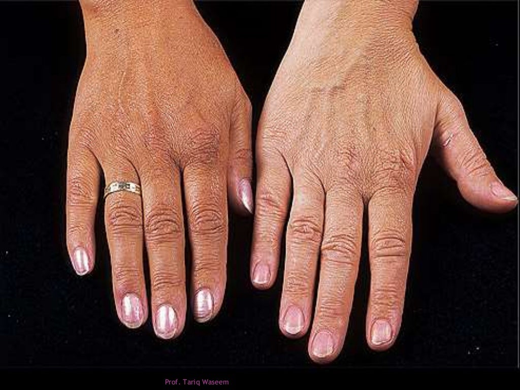 arthritis adrenaline disorder arthritis adrenaline disorder