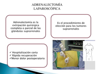 Adrenalectomía | PPTX