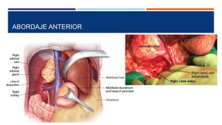 Adrenalectomia | PPTX