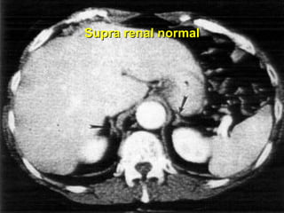 Supra renal normal 
