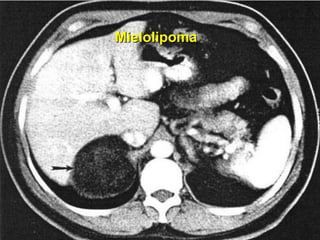 Mielolipoma  