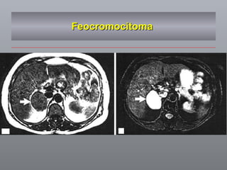Feocromocitoma  