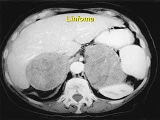Linfoma 