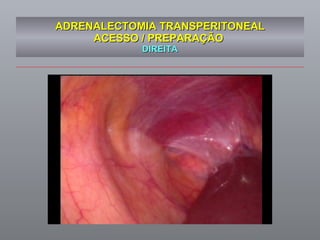 ADRENALECTOMIA TRANSPERITONEAL ACESSO / PREPARAÇÃO  DIREITA 