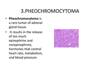 3.PHEOCHROMOCYTOMA
• Pheochromocytoma is
a rare tumor of adrenal
gland tissue.
• It results in the release
of too much
epinephrine and
norepinephrine,
hormones that control
heart rate, metabolism,
and blood pressure.
 