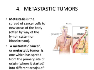 4. METASTASTIC TUMORS
• Metastasis is the
spread of cancer cells to
new areas of the body
(often by way of the
lymph system or
bloodstream).
• A metastatic cancer,
or metastatic tumor, is
one which has spread
from the primary site of
origin (where it started)
into different area(s) of
 