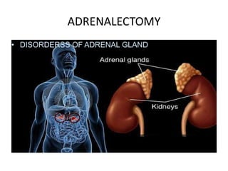 View of Adrenalectomy new | PPTX