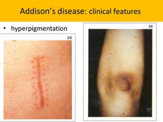 Addison’s disease: clinical features
• hyperpigmentation
 