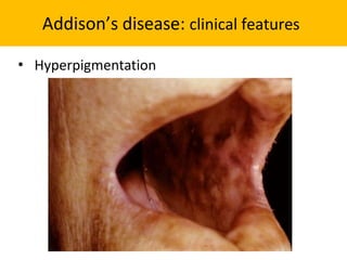 Addison’s disease: clinical features
• Hyperpigmentation
 