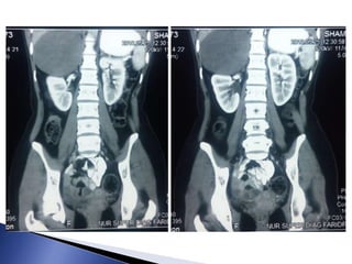 A 16 year old girl with right loin pain due to Adrenal ganglioneuroma.pptx