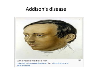 Addison’s disease
 