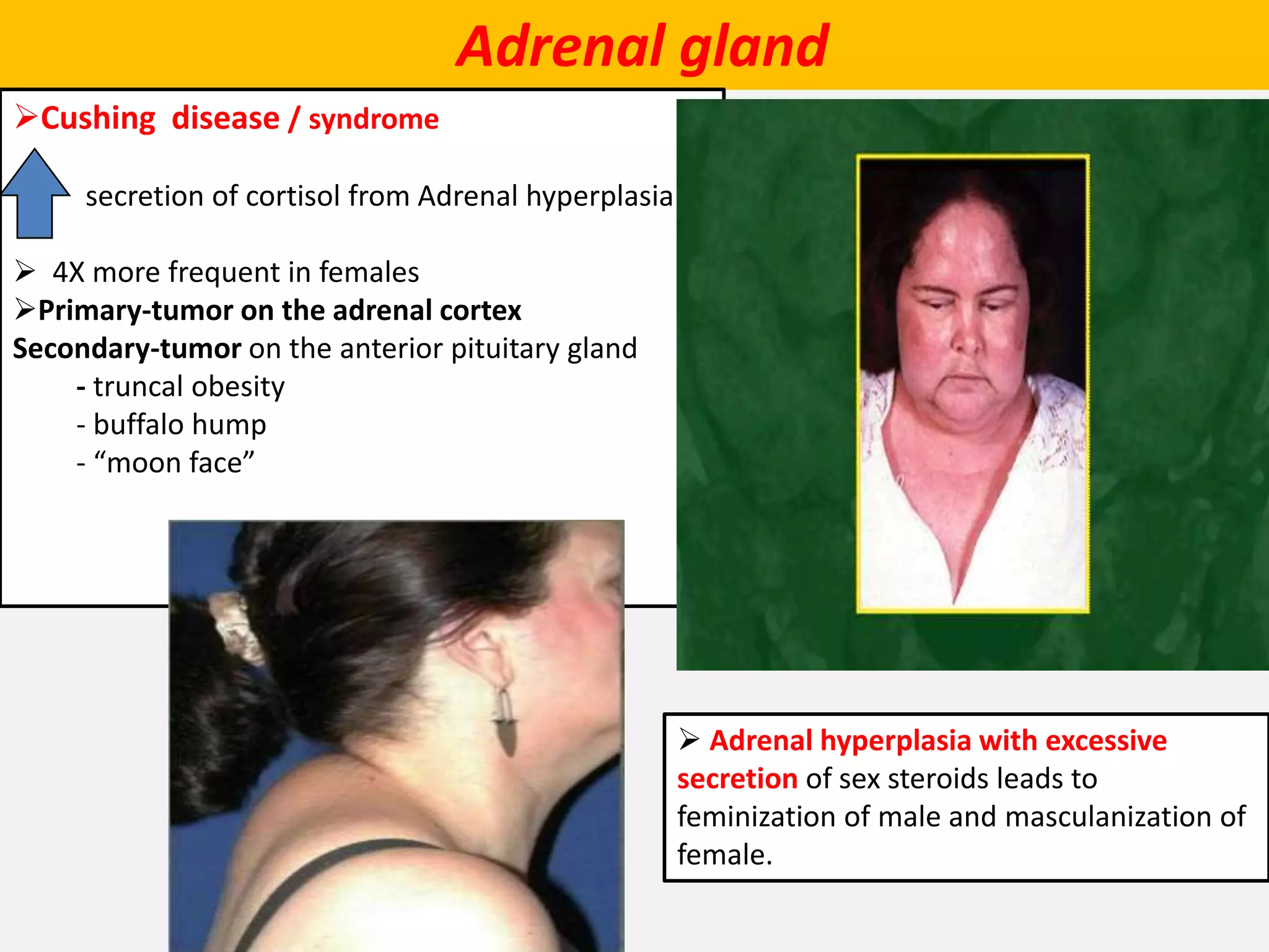 Adrenal gland
Cushing disease / syndrome
secretion of cortisol from Adrenal hyperplasia
 4X more frequent in females
Primary-tumor on the adrenal cortex
Secondary-tumor on the anterior pituitary gland
- truncal obesity
- buffalo hump
- “moon face”
 Adrenal hyperplasia with excessive
secretion of sex steroids leads to
feminization of male and masculanization of
female.
 