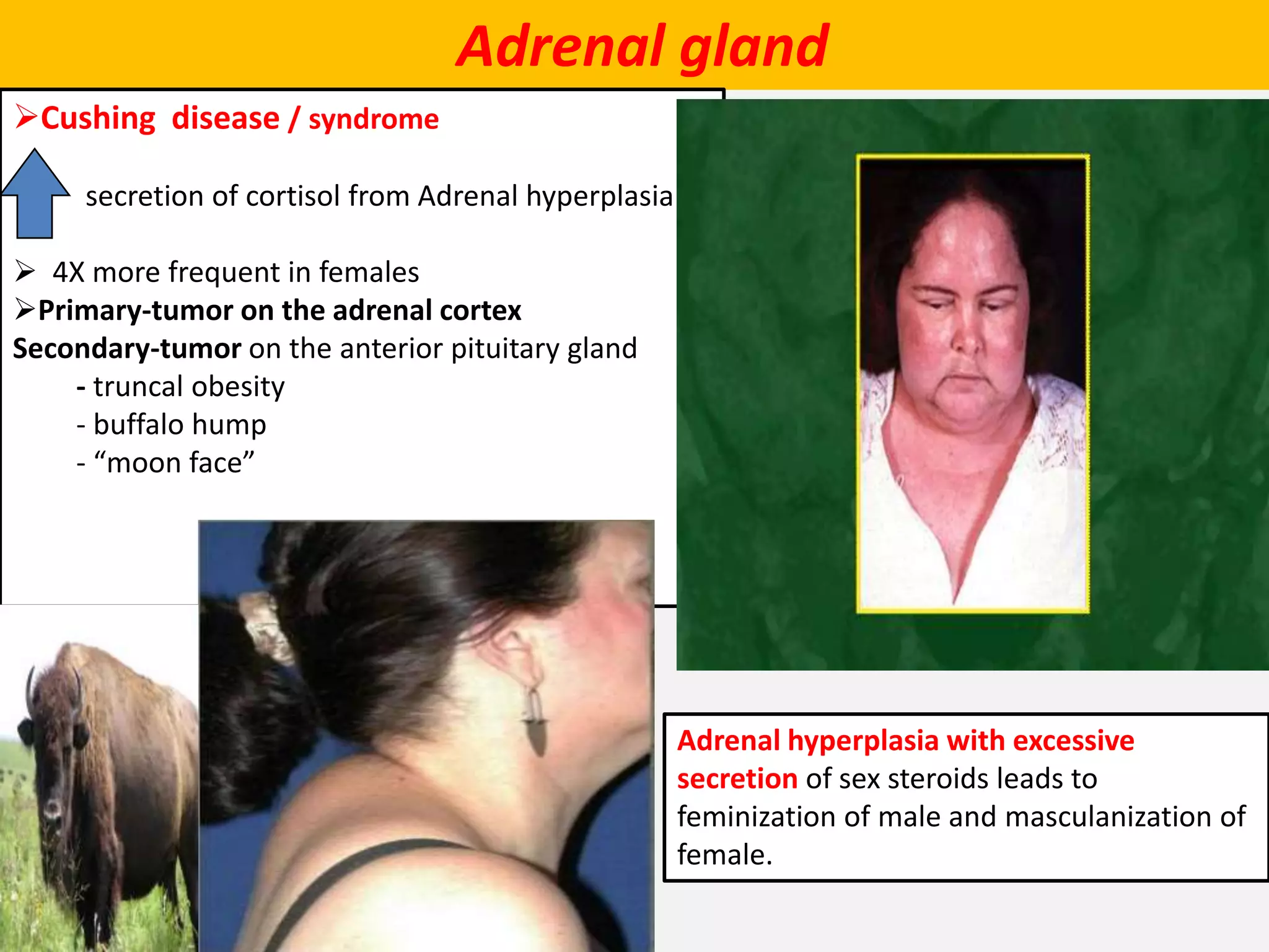 Adrenal gland
Cushing disease / syndrome
secretion of cortisol from Adrenal hyperplasia
 4X more frequent in females
Primary-tumor on the adrenal cortex
Secondary-tumor on the anterior pituitary gland
- truncal obesity
- buffalo hump
- “moon face”
Adrenal hyperplasia with excessive
secretion of sex steroids leads to
feminization of male and masculanization of
female.
 