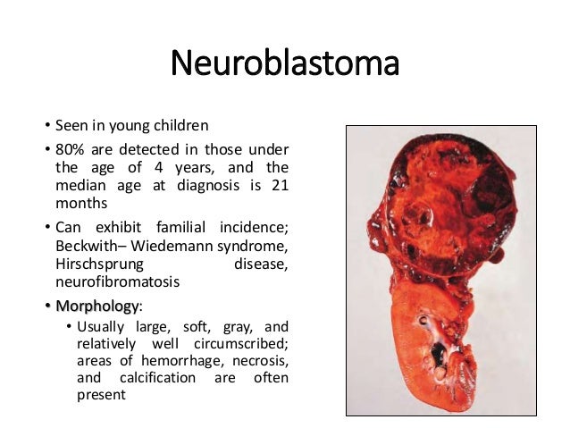 adrenal nodule on kidney adrenal nodule on kidney