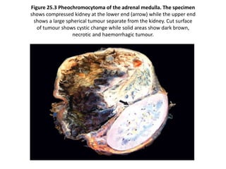 Figure 25.3 Pheochromocytoma of the adrenal medulla. The specimen
shows compressed kidney at the lower end (arrow) while the upper end
shows a large spherical tumour separate from the kidney. Cut surface
of tumour shows cystic change while solid areas show dark brown,
necrotic and haemorrhagic tumour.
 