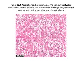 Figure 25.4 Adrenal pheochromocytoma. The tumour has typical
zellballen or nested pattern. The tumour cells are large, polyhedral and
pleomorphic having abundant granular cytoplasm.
 