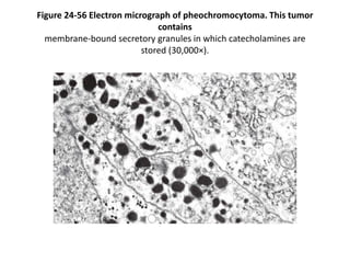 Figure 24-56 Electron micrograph of pheochromocytoma. This tumor
contains
membrane-bound secretory granules in which catecholamines are
stored (30,000×).
 
