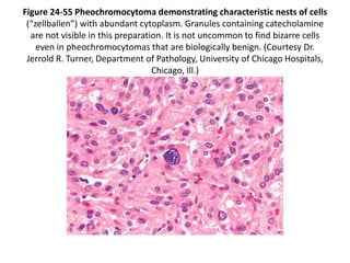 Figure 24-55 Pheochromocytoma demonstrating characteristic nests of cells
(“zellballen”) with abundant cytoplasm. Granules containing catecholamine
are not visible in this preparation. It is not uncommon to find bizarre cells
even in pheochromocytomas that are biologically benign. (Courtesy Dr.
Jerrold R. Turner, Department of Pathology, University of Chicago Hospitals,
Chicago, Ill.)
 