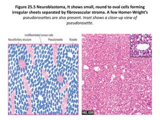 Figure 25.5 Neuroblastoma, It shows small, round to oval cells forming
irregular sheets separated by fibrovascular stroma. A few Homer-Wright’s
pseudorosettes are also present. Inset shows a close-up view of
pseudorosette.
 