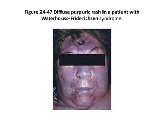 Figure 24-47 Diffuse purpuric rash in a patient with
Waterhouse-Friderichsen syndrome.
 