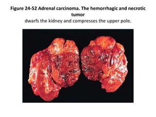 Figure 24-52 Adrenal carcinoma. The hemorrhagic and necrotic
tumor
dwarfs the kidney and compresses the upper pole.
 