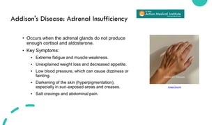 Common Signs and Symptoms of Adrenal Gland Disorders | PDF