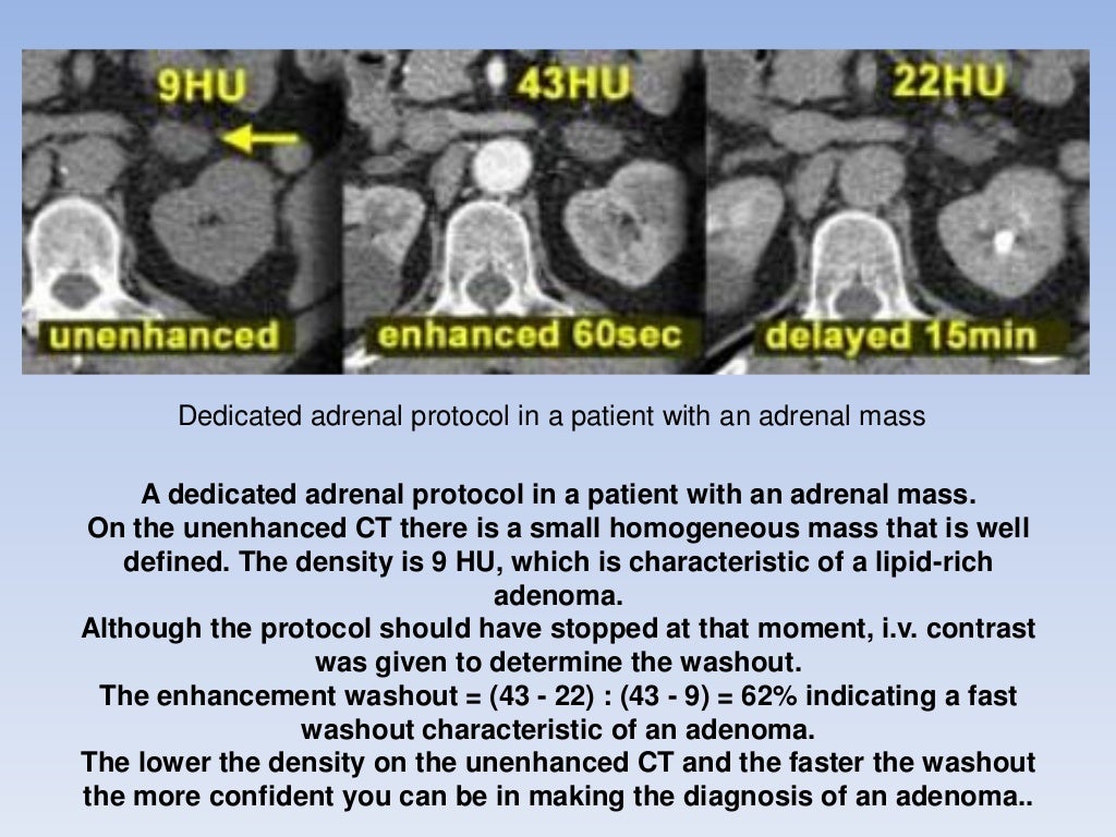 Adrenal gland tumors (Radiology)