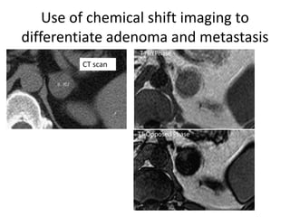 Use of chemical shift imaging to
differentiate adenoma and metastasis
CT scan
 