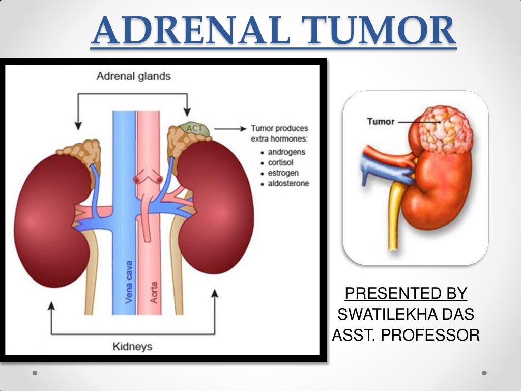 Adrenal tumor, classification, management easy explanation