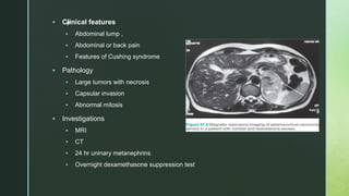 z
 Clinical features
 Abdominal lump ,
 Abdominal or back pain
 Features of Cushing syndrome
 Pathology
 Large tumors with necrosis
 Capsular invasion
 Abnormal mitosis
 Investigations
 MRI
 CT
 24 hr uninary metanephrins
 Overnight dexamethasone suppression test
 
