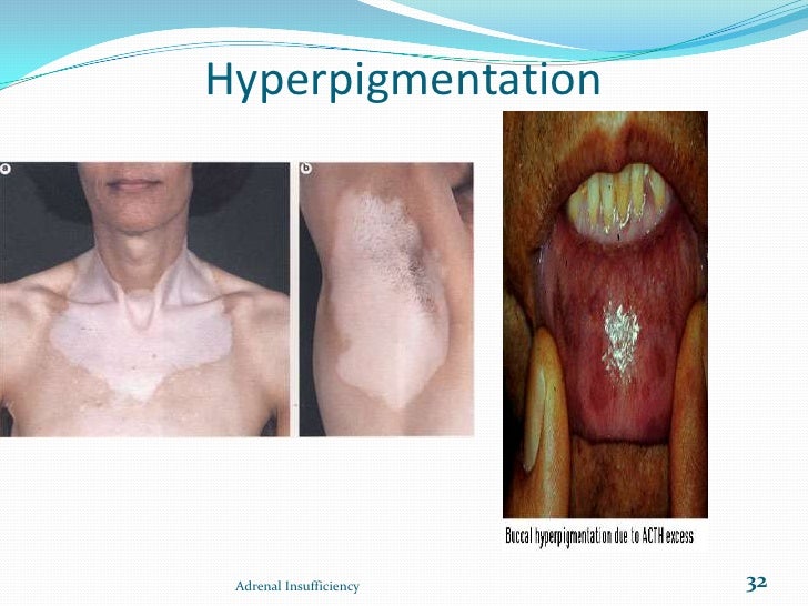 Adrencortical hypofunction