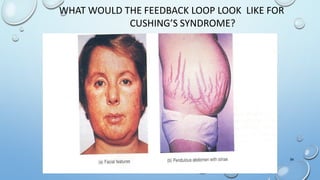WHAT WOULD THE FEEDBACK LOOP LOOK LIKE FOR
CUSHING’S SYNDROME?
54
 