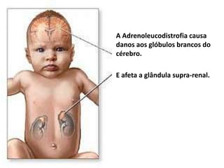 A Adrenoleucodistrofia causa danos aos glóbulos brancos do cérebro.E afeta a glândula supra-renal.