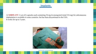 41
Hormonal contraceptives
Implants
1] NORPLANT: A set of 6 capsules each containing 36 mg levonorgestrel (total 216 mg) for subcutaneous
implantation is available in some countries. but has been discontinued in the USA.
It works for up to 5 years.
 