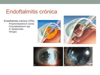 Endoftalmitis crónica
Endoftalmitis crónica (10%)
Proprionibacterium acnes
Corynebacterium spp
S. Epidermidis
Hongos
 